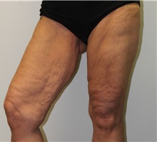 Thigh Lift Before Photo by James Lee, MD; Laval, QC - Case 35566