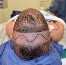 Craniosynostosis Before Photo by Rachel Ruotolo, MD; Garden City, NY - Case 35573