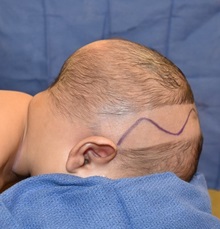 Craniosynostosis Before Photo by Rachel Ruotolo, MD; Garden City, NY - Case 35573