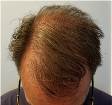 Hair Transplant After Photo by Pramit Malhotra, MD; Ann Arbor, MI - Case 35679