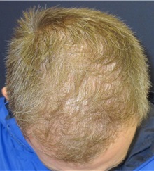 Hair Transplant After Photo by Pramit Malhotra, MD; Ann Arbor, MI - Case 35680