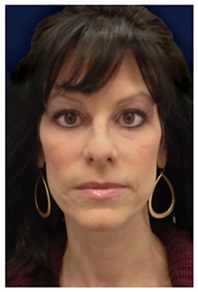 Dermal Fillers Before Photo by Michael Law, MD; Raleigh, NC - Case 35747