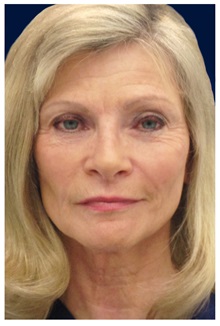 Dermal Fillers After Photo by Michael Law, MD; Raleigh, NC - Case 35748