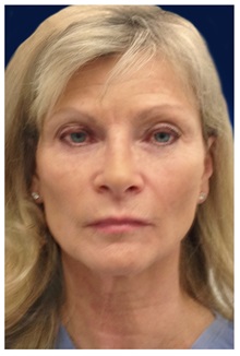 Dermal Fillers Before Photo by Michael Law, MD; Raleigh, NC - Case 35748