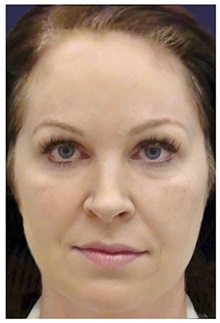 Dermal Fillers Before Photo by Michael Law, MD; Raleigh, NC - Case 35749