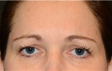 Botulinum Toxin After Photo by Michael Law, MD; Raleigh, NC - Case 35760