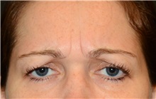 Botulinum Toxin Before Photo by Michael Law, MD; Raleigh, NC - Case 35760