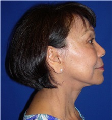 Facelift After Photo by Robert Kessler, MD; Corona Del Mar, CA - Case 35780