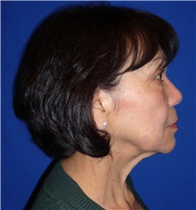 Facelift Before Photo by Robert Kessler, MD; Corona Del Mar, CA - Case 35780