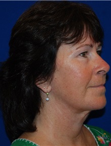 Facelift After Photo by Robert Kessler, MD; Corona Del Mar, CA - Case 35786