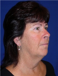 Facelift Before Photo by Robert Kessler, MD; Corona Del Mar, CA - Case 35786