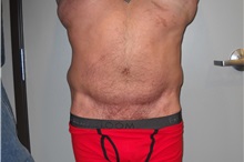 Tummy Tuck After Photo by Ellen Janetzke, MD; Bloomfield Hills, MI - Case 35817