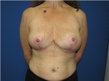 Breast Implant Removal After Photo by Trent Douglas, MD; Greenbrae, CA - Case 35869