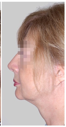 Facelift After Photo by Darrick Antell, MD; New York, NY - Case 36078