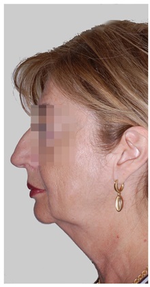 Facelift Before Photo by Darrick Antell, MD; New York, NY - Case 36078