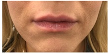 Botulinum Toxin After Photo by Darrick Antell, MD; New York, NY - Case 36087