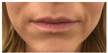 Botulinum Toxin Before Photo by Darrick Antell, MD; New York, NY - Case 36087