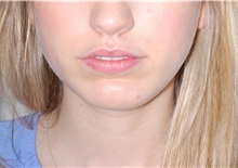 Chin Augmentation After Photo by Darrick Antell, MD; New York, NY - Case 36143