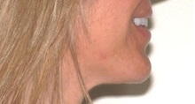 Chin Augmentation After Photo by Darrick Antell, MD; New York, NY - Case 36145