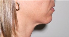 Chin Augmentation Before Photo by Darrick Antell, MD; New York, NY - Case 36145