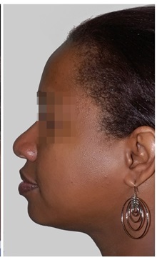 Chin Augmentation After Photo by Darrick Antell, MD; New York, NY - Case 36146