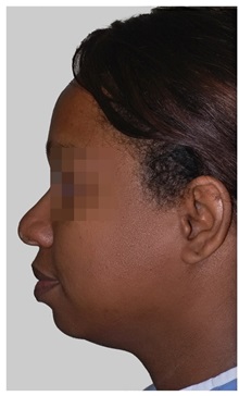 Chin Augmentation Before Photo by Darrick Antell, MD; New York, NY - Case 36146