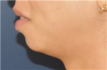 Chin Augmentation Before Photo by Richard Reish, MD, FACS; New York, NY - Case 36258