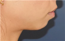 Chin Augmentation Before Photo by Richard Reish, MD, FACS; New York, NY - Case 36258