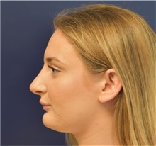 Rhinoplasty After Photo by Richard Reish, MD, FACS; New York, NY - Case 36266