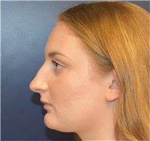 Rhinoplasty Before Photo by Richard Reish, MD, FACS; New York, NY - Case 36266