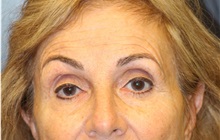 Eyelid Surgery Before Photo by Laurence Glickman, MD, MSc, FRCS(c),  FACS; Garden City, NY - Case 36328