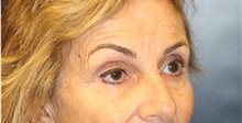 Eyelid Surgery Before Photo by Laurence Glickman, MD, MSc, FRCS(c),  FACS; Garden City, NY - Case 36328