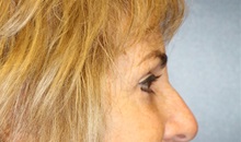 Eyelid Surgery After Photo by Laurence Glickman, MD, MSc, FRCS(c),  FACS; Garden City, NY - Case 36328