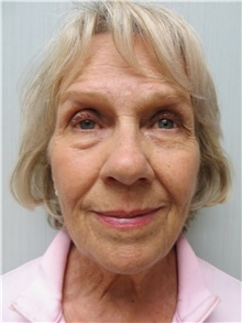 Facelift Before Photo by Richard Greco, MD; Savannah, GA - Case 36417