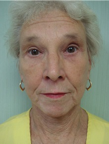 Facelift After Photo by Richard Greco, MD; Savannah, GA - Case 36420