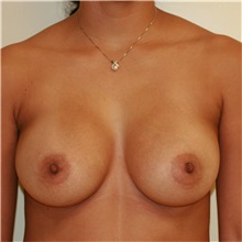 Breast Augmentation After Photo by Steve Laverson, MD, FACS; Rancho Santa Fe, CA - Case 36681