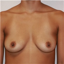 Breast Augmentation Before Photo by Steve Laverson, MD, FACS; Rancho Santa Fe, CA - Case 36681