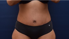 Tummy Tuck After Photo by Michael Dobryansky, MD, FACS; Garden City, NY - Case 36753