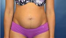 Tummy Tuck Before Photo by Michael Dobryansky, MD, FACS; Garden City, NY - Case 36753