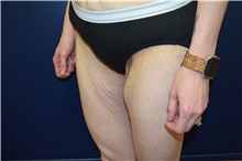 Thigh Lift Before Photo by Michael Dobryansky, MD, FACS; Garden City, NY - Case 36765