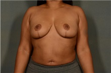 Breast Reduction After Photo by Ellen Janetzke, MD; Bloomfield Hills, MI - Case 36796