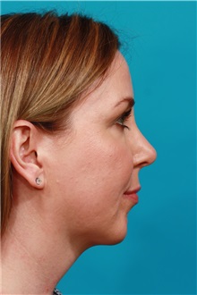 Chin Augmentation After Photo by Michael Bogdan, MD, MBA, FACS; Grapevine, TX - Case 36904