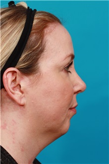 Chin Augmentation Before Photo by Michael Bogdan, MD, MBA, FACS; Grapevine, TX - Case 36904