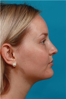 Rhinoplasty After Photo by Michael Bogdan, MD, MBA, FACS; Grapevine, TX - Case 36908