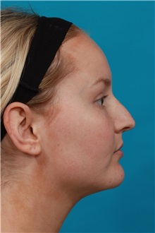 Rhinoplasty Before Photo by Michael Bogdan, MD, MBA, FACS; Grapevine, TX - Case 36908