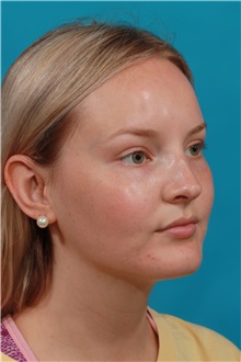 Rhinoplasty After Photo by Michael Bogdan, MD, MBA, FACS; Grapevine, TX - Case 36908