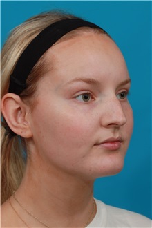 Rhinoplasty Before Photo by Michael Bogdan, MD, MBA, FACS; Grapevine, TX - Case 36908