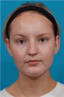 Rhinoplasty Before Photo by Michael Bogdan, MD, MBA, FACS; Grapevine, TX - Case 36908