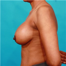 Breast Augmentation After Photo by Michael Bogdan, MD, MBA, FACS; Grapevine, TX - Case 36979