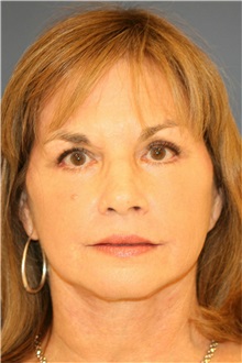 Facelift After Photo by Steve Laverson, MD, FACS; Rancho Santa Fe, CA - Case 37394